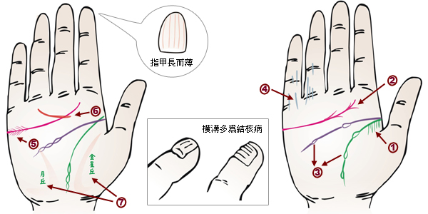 掌紋分析：肺結核掌徵