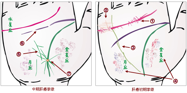 掌紋分析:肝癌掌徵