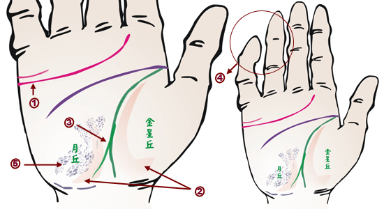 掌纹分析：风湿病掌徵