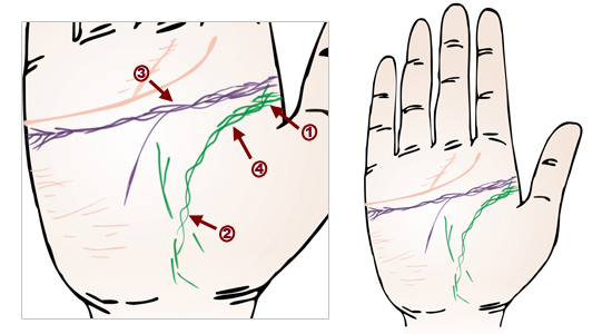 掌紋分析：長期神經痛掌徵